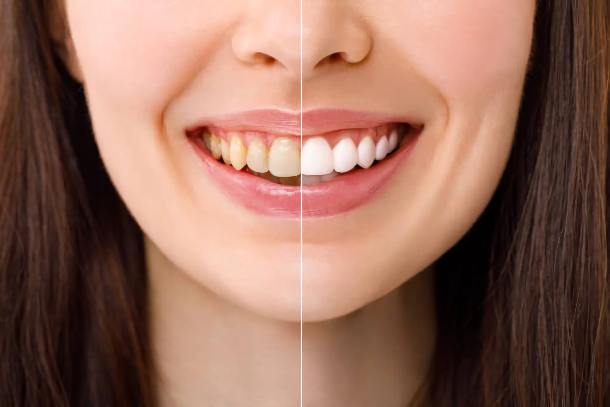 Blanqueamiento dental con peróxido de hidrógeno